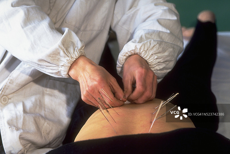 针灸治疗中的患者图片素材