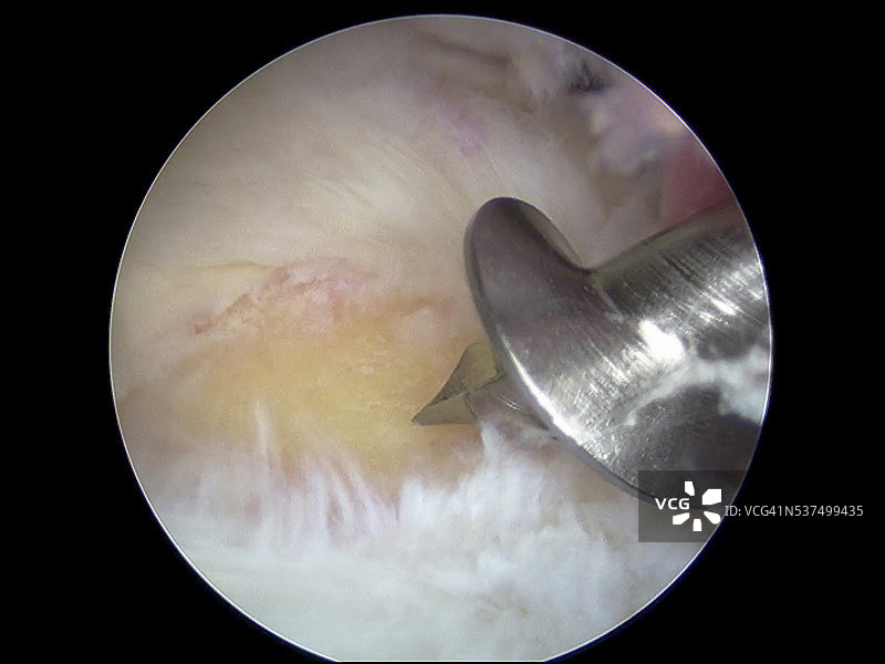 钛缝线螺钉袖带修复锚的关节镜视图图片素材