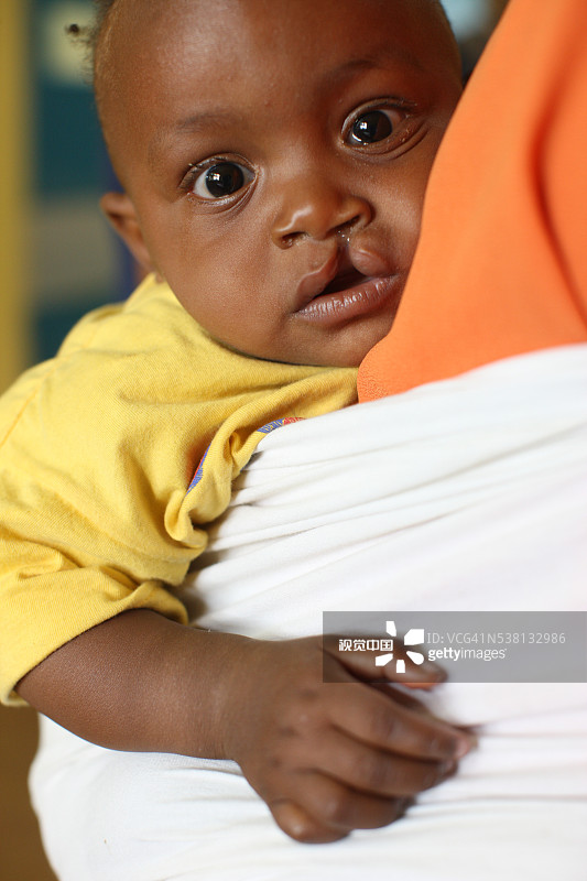 布拉柴维尔医院儿科病房中患有唇裂的儿童图片素材