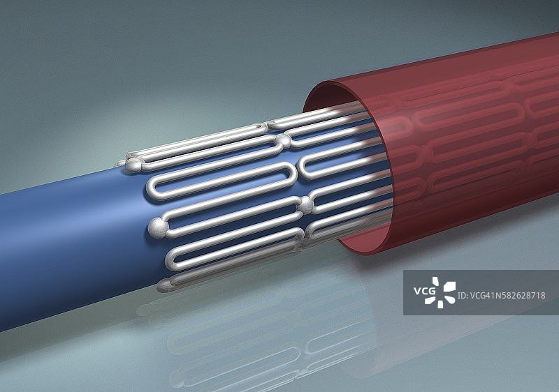 动脉支架图片素材