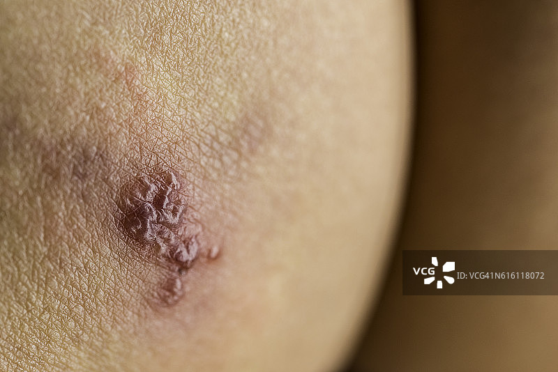 带状疱疹图片素材