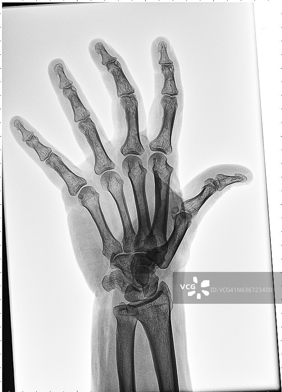 手部X光片图片素材