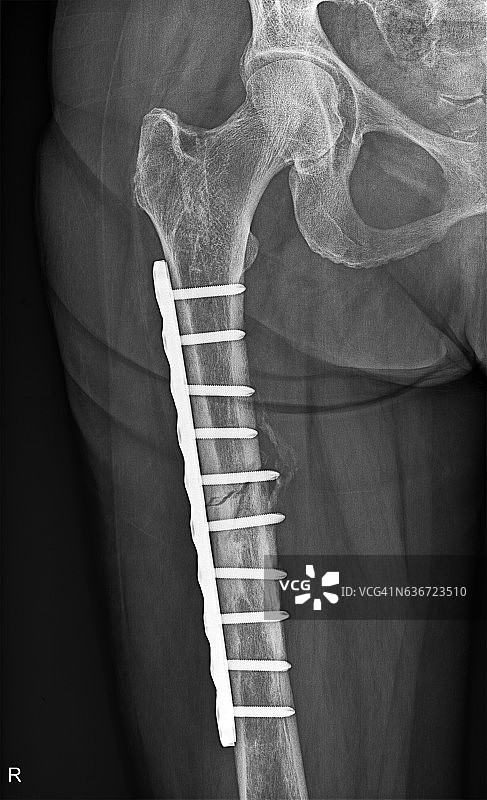 股骨骨折术后图片素材