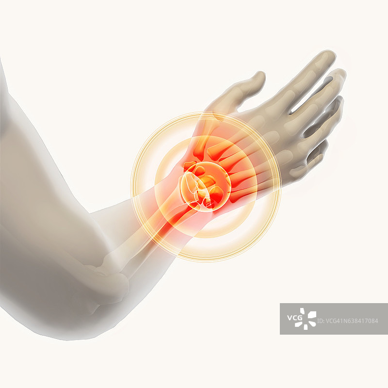 手腕疼痛的X光片图片素材