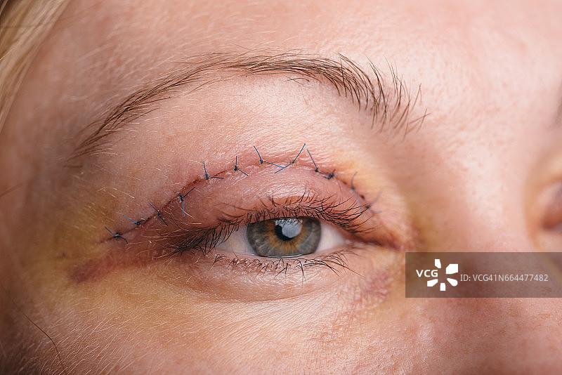 上眼睑的眼睑成形术图片素材