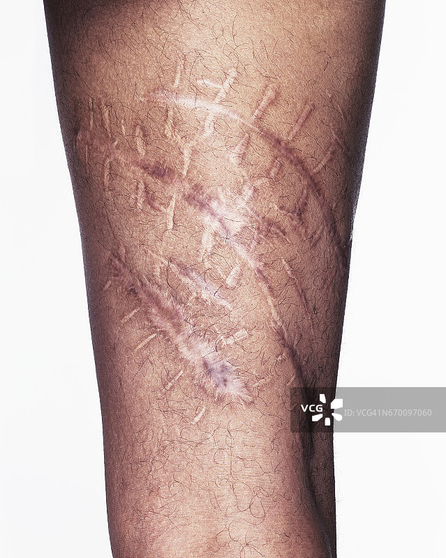 美国退伍军人伊拉克战争疤痕细节图片素材