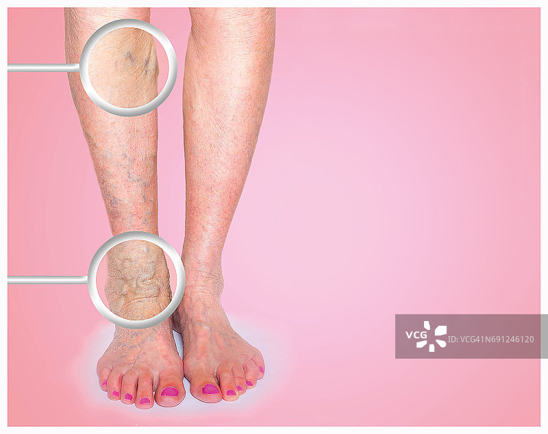 女性腿部的静脉曲张图片素材