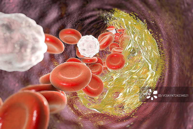 动脉粥样硬化斑块破坏示意图图片素材