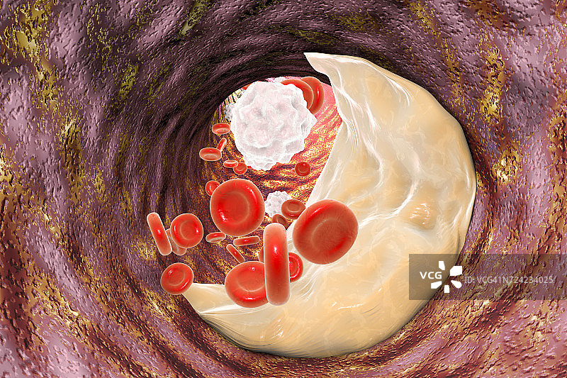 动脉粥样硬化斑块，图示图片素材