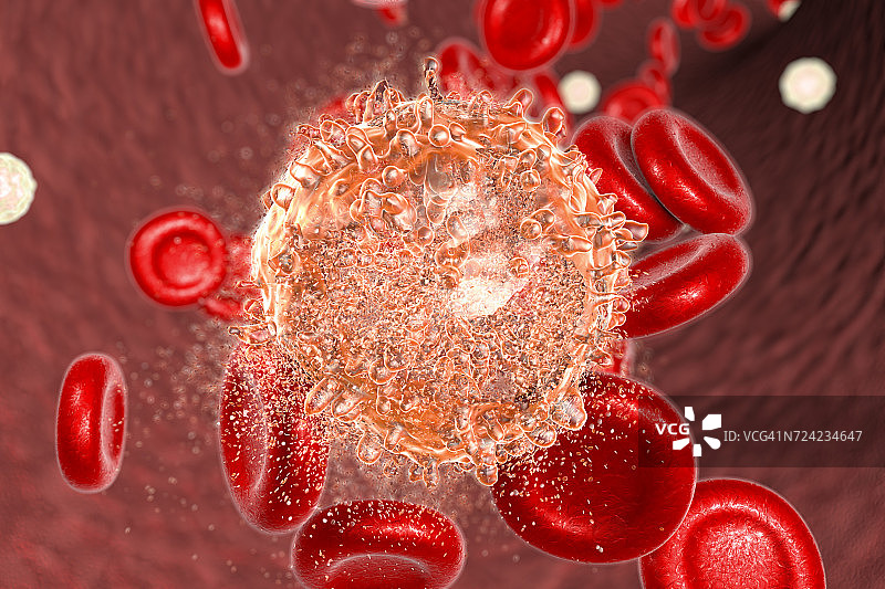白血病血细胞破坏，图示图片素材