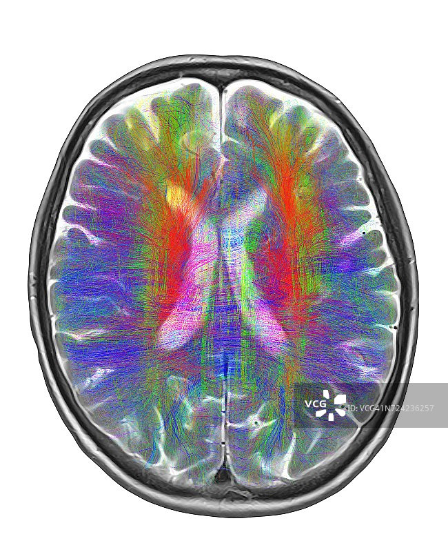 大脑核磁共振成像和白质纤维图片素材