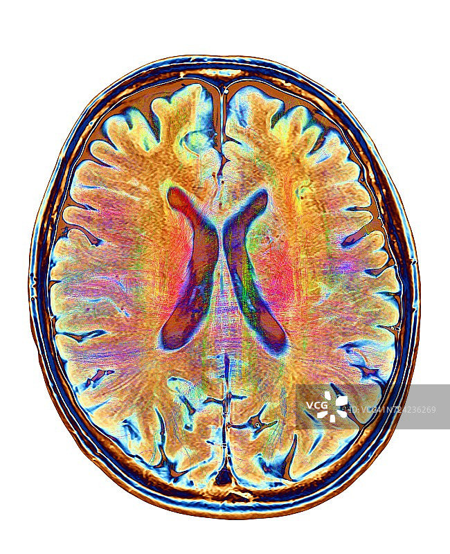 大脑核磁共振成像和白质纤维图片素材