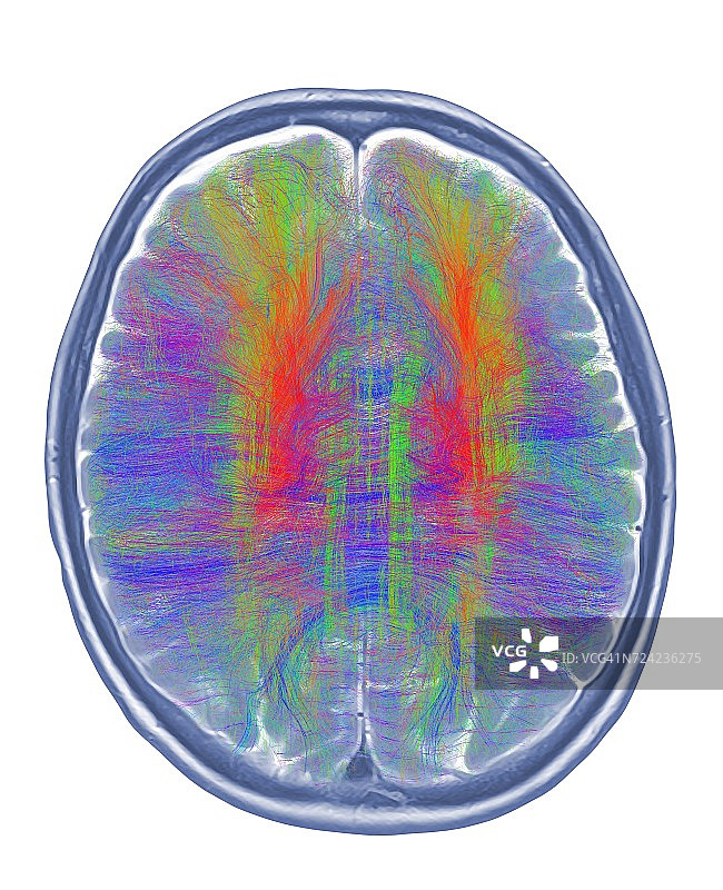 大脑核磁共振成像和白质纤维图片素材