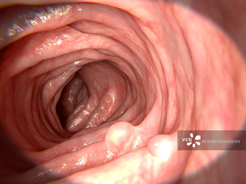 肠道息肉插图图片素材