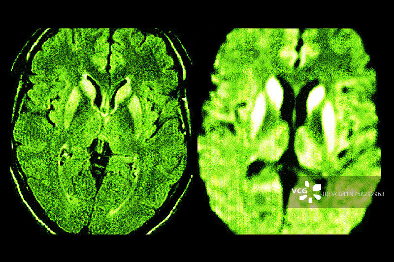 克雅氏病MRI图片素材