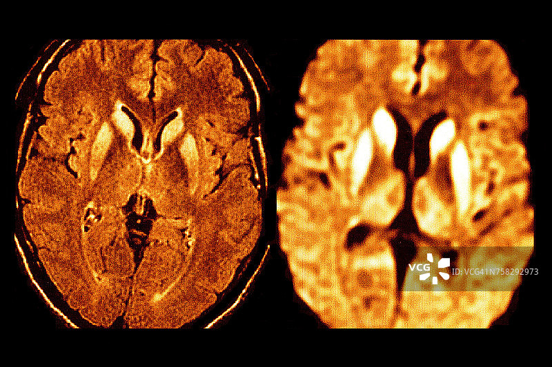 克雅氏病MRI图片素材