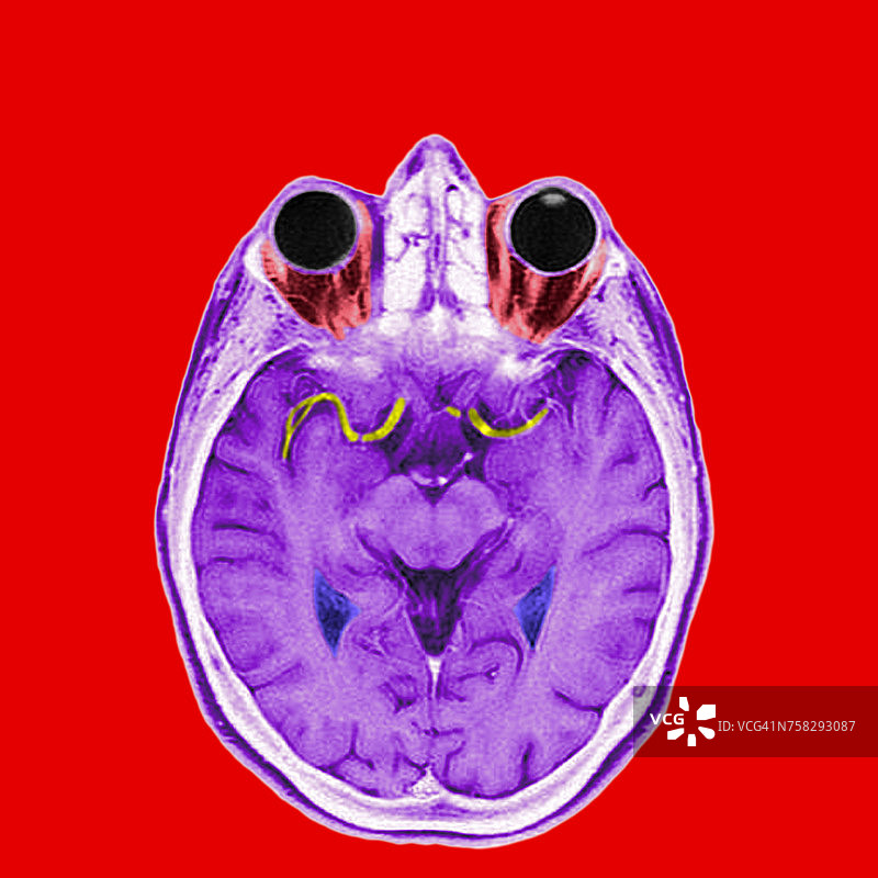 头部核磁共振图片素材