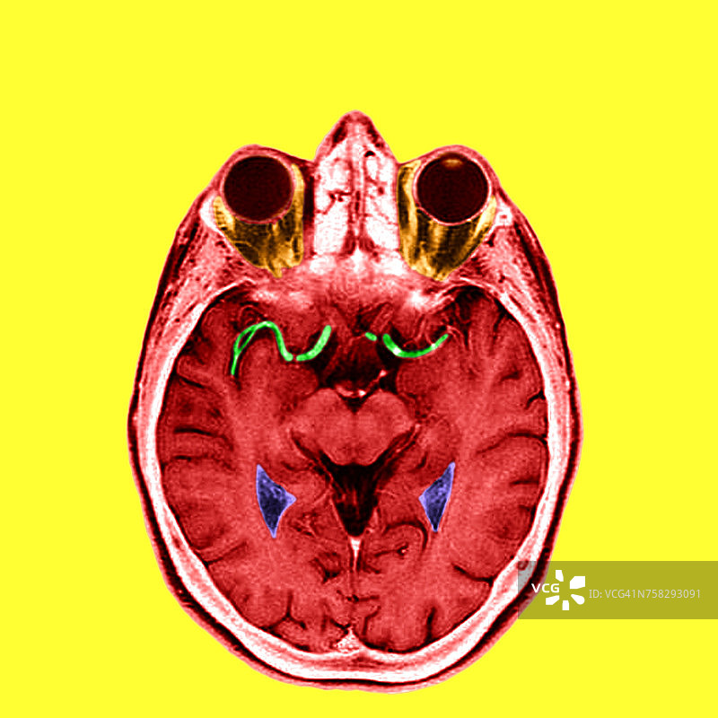 头部核磁共振图片素材