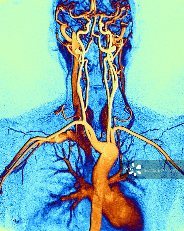 胸部、颈部和头部动脉的MRI扫描图片素材