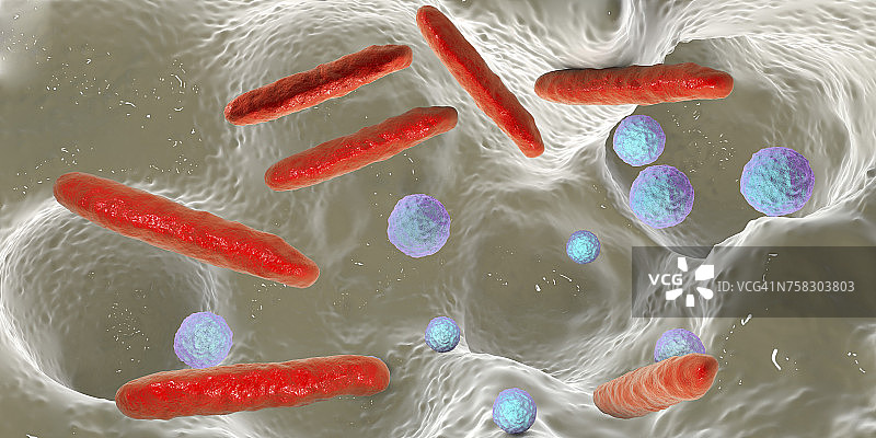 牙洞内的细菌，图示图片素材