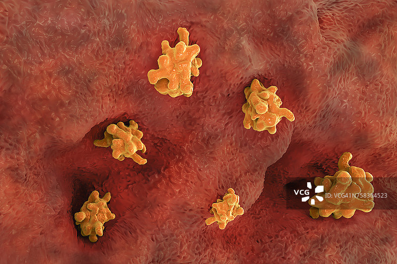 寄生阿米巴虫（溶组织内阿米巴）侵入肠道图片素材