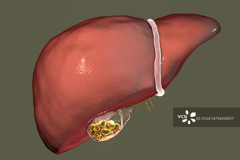 胆结石插图图片素材
