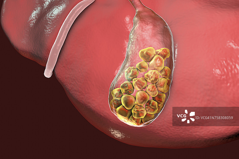 胆结石插图图片素材