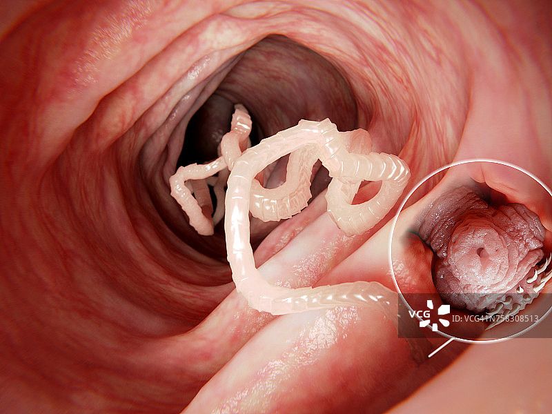 人体肠道中的绦虫插图图片素材