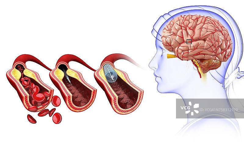 中风治疗插画图片素材