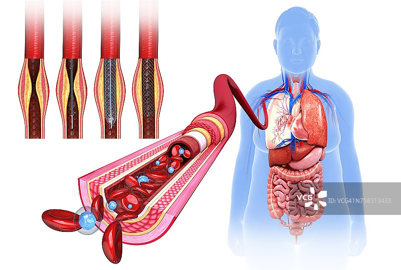 动脉阻塞支架治疗插图图片素材