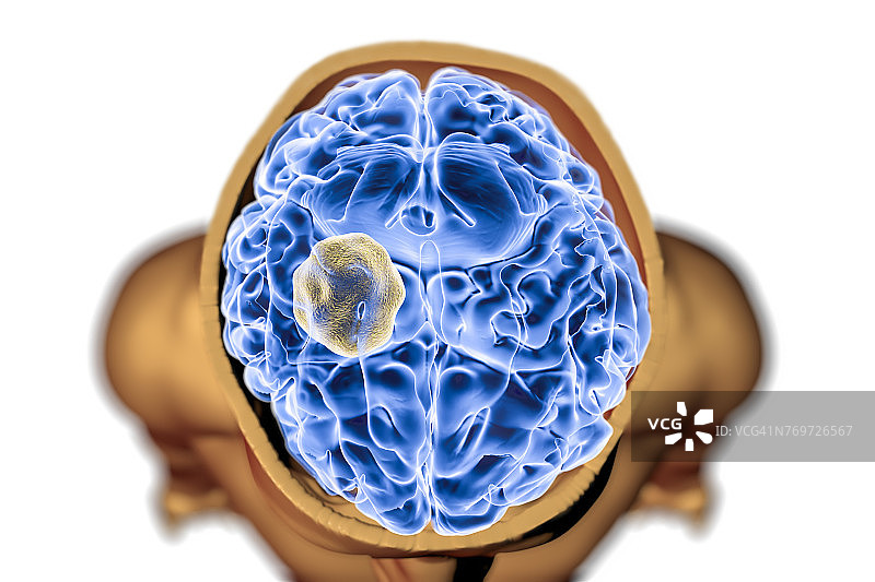 脑曲霉菌球图示图片素材