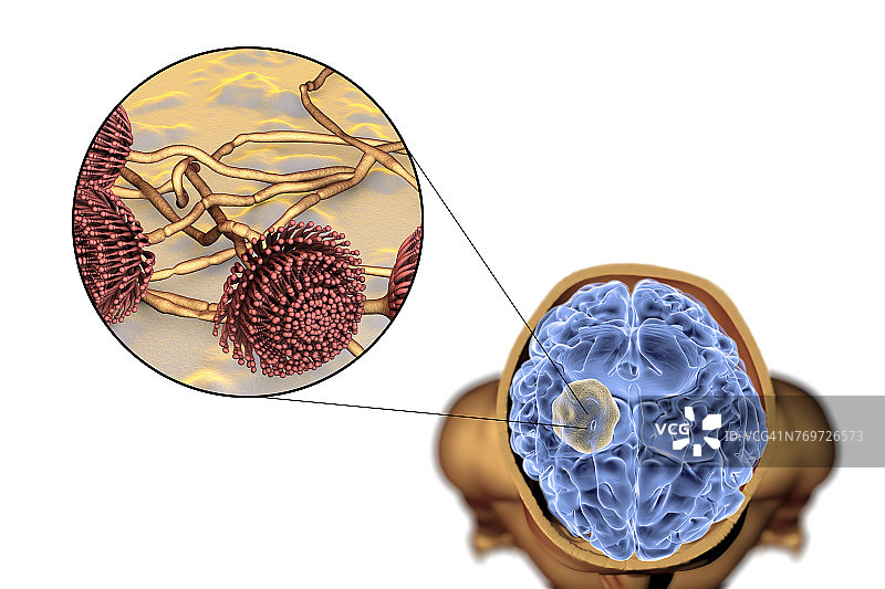脑曲霉菌球图示图片素材