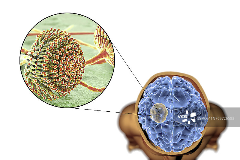 脑曲霉菌球图示图片素材