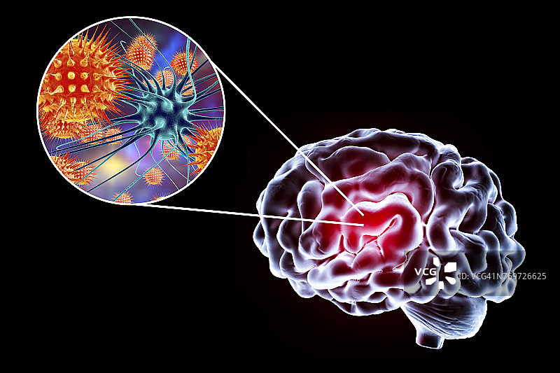 病毒性脑炎，插图图片素材