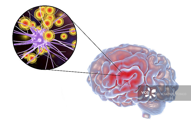病毒性脑炎，插图图片素材
