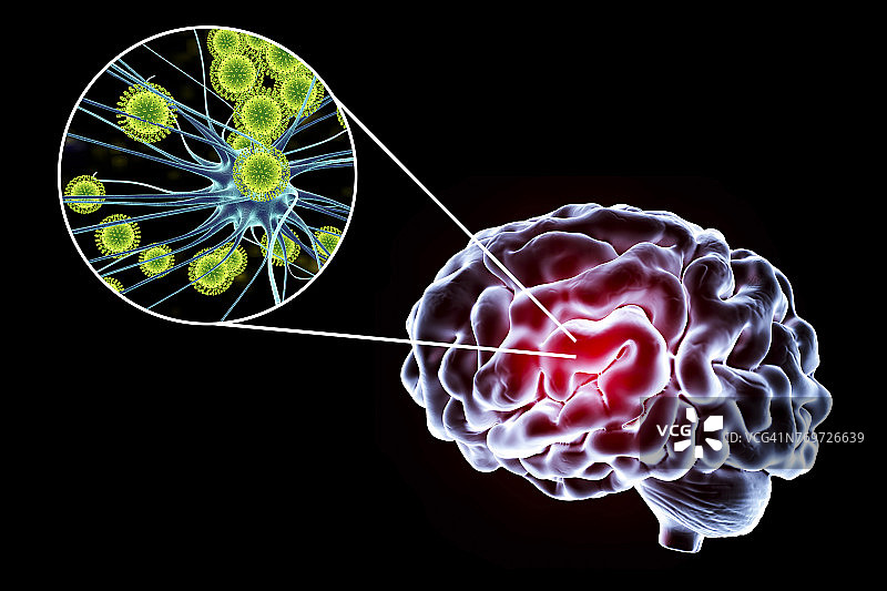 病毒性脑炎，插图图片素材