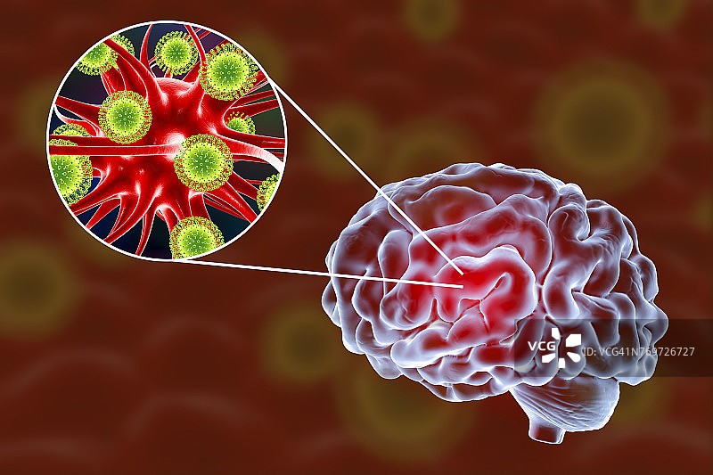 病毒性脑炎，插图图片素材