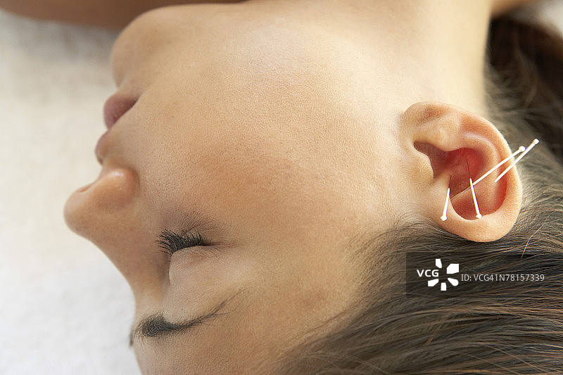 刺在女人耳朵上的针灸针图片素材