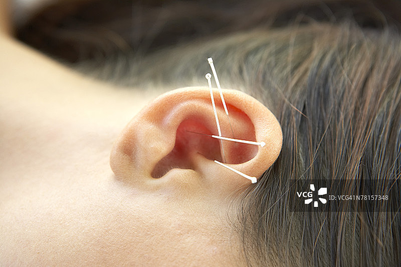 刺在女人耳朵上的针灸针图片素材