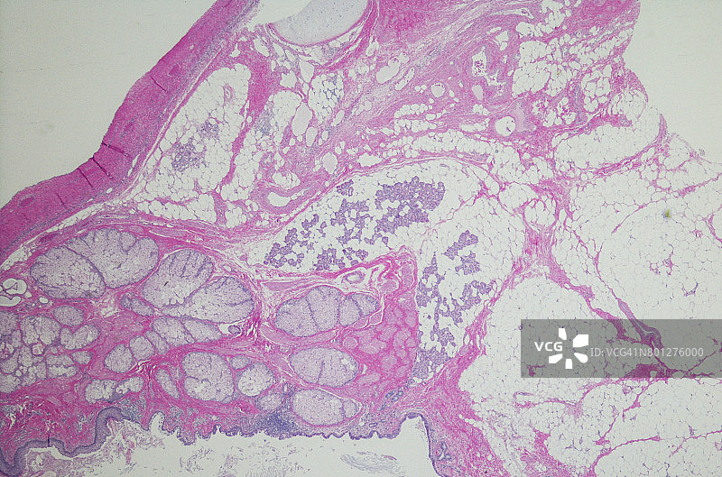 成熟的囊性卵巢畸胎瘤图片素材