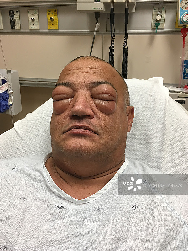 海鲜过敏：成年男子在医院病床上出现严重过敏反应并接受医疗护理图片素材