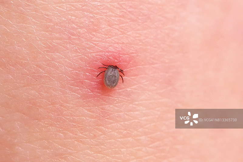 蜱虫叮咬人图片素材