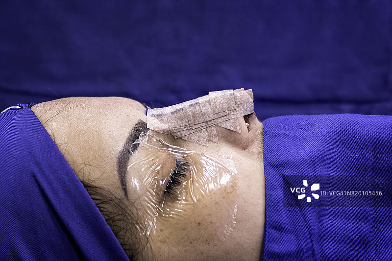 女性患者鼻中隔偏曲和隆鼻术后的鼻部轮廓特写图片素材