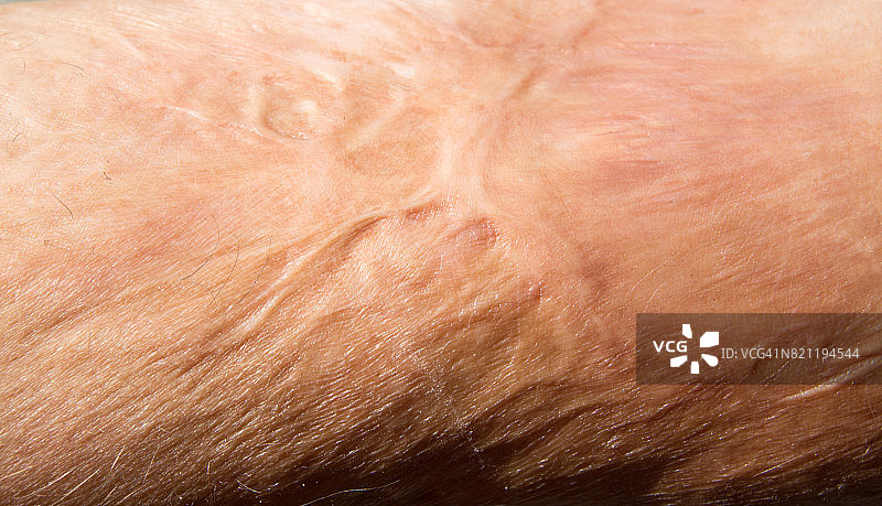 烧伤痕迹图片素材