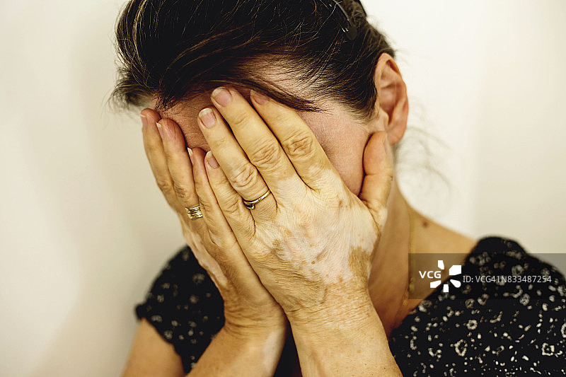 白癜风女人肖像图片素材