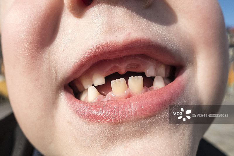 掉牙的小男孩图片素材