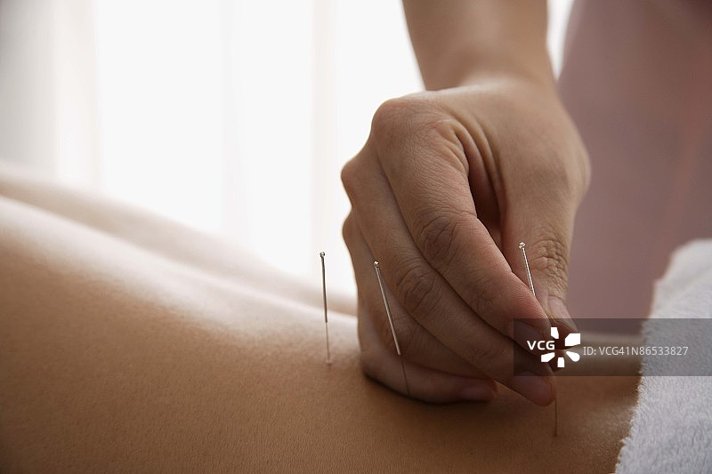 用于针灸治疗的背部针刺图片素材