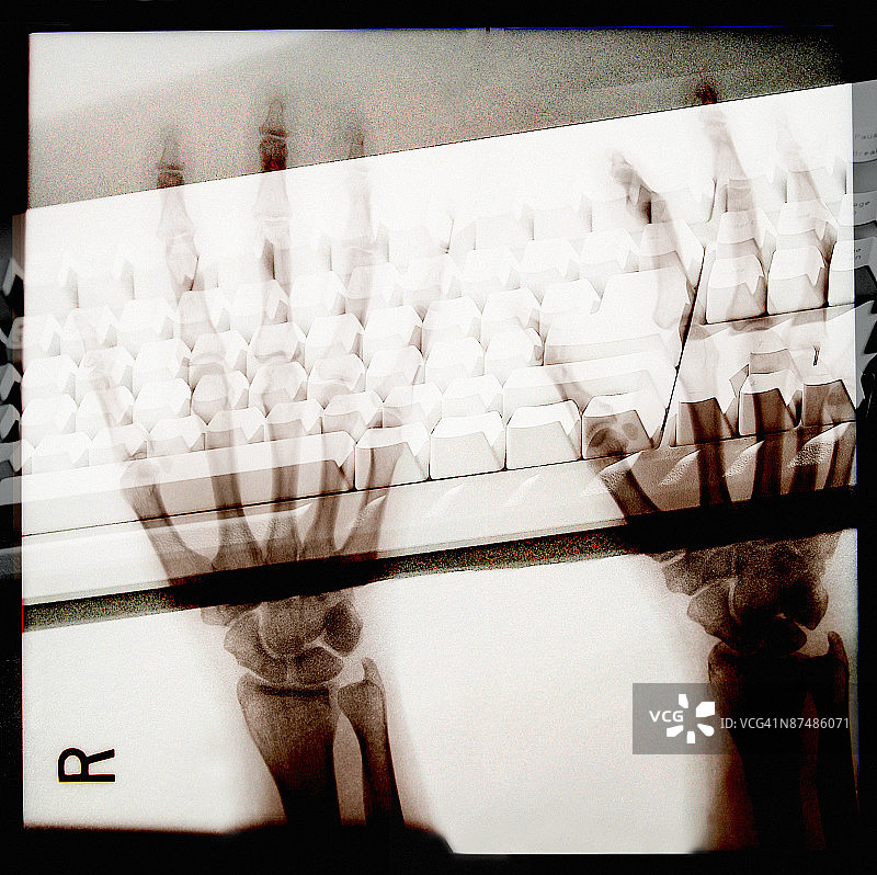 腕管综合征图片素材