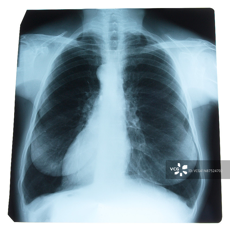 胸部X光片图片素材