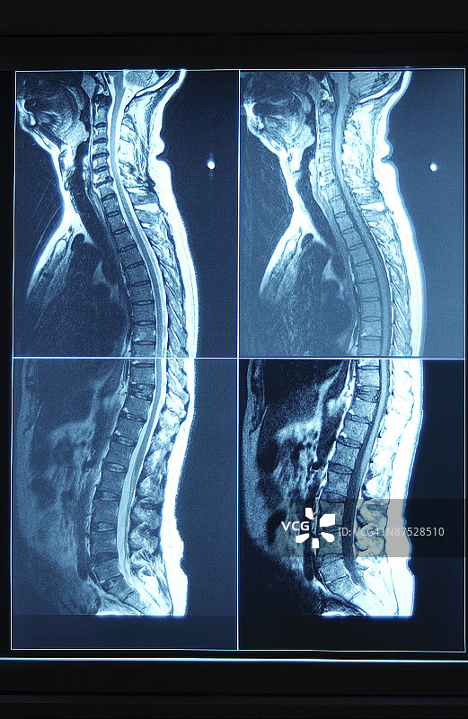 脊柱X光片图片素材